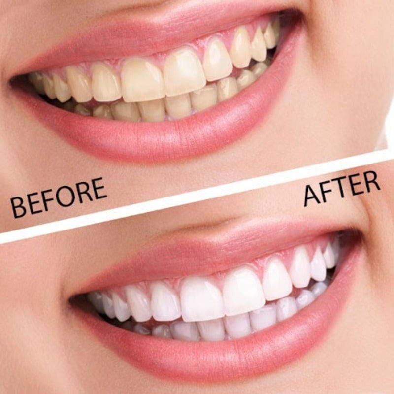 Remedy Health Health Professional Remedy Health Professional Teeth Whitening Home Kit TWK001 (6955042406489)